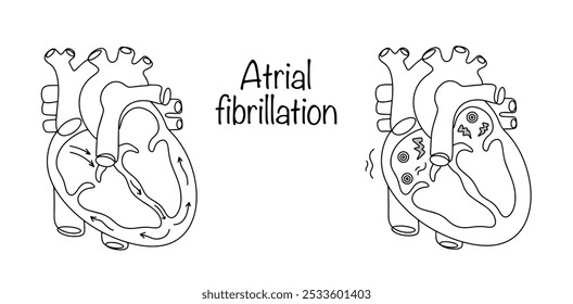 Fibrilhação auricular. Alteração do ritmo cardíaco com contração assíncrona dos átrios e ventrículos. Desenhar coração e coração saudáveis com arritmia cardíaca. Ilustração vetorial.