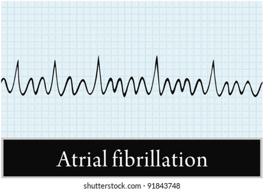 atrial fibrillation Vector. Professional information