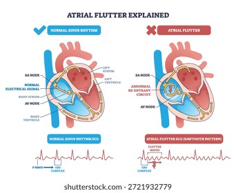El diagrama explicado del aleteo auricular contrasta el ritmo normal con el circuito de reentrada en el corazón, destacando el nodo SA, el nodo AV y el patrón de ECG de diente de sierra para mayor claridad. Esquema del diagrama