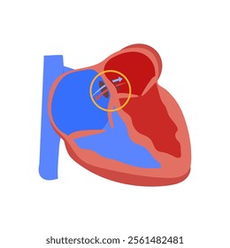 Atrial Septal Defect, Cardiovascular Disease Illustration Icon