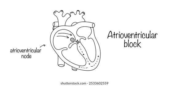 Bloqueo auriculoventricular. Alteración en la conducción de impulsos eléctricos desde las aurículas a los ventrículos. Ilustración médica con una línea que muestra la enfermedad cardíaca. Vector aislado.