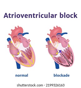 Atrioventricular Block. Violation Of The Electrical Signal In The Heart. Medical Vector Illustration