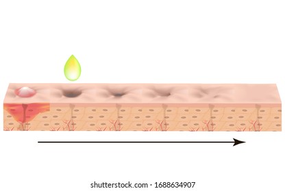 Atrophic scars. Acne scar. The anatomical structure of the skin with acne. Vector illustration on isolated background.