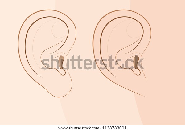 Attached earlobe and free earlobe in\
comparison. Different looks of the human ear because of recessive\
gene frequency. Comic vector\
illustration.