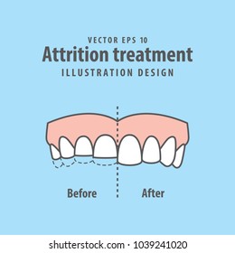 what is clenching teeth a symptom of