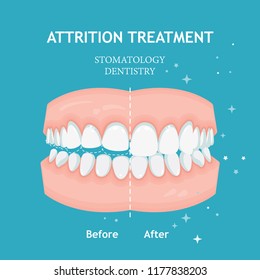 Attrition treatment vector. Stomatology dentistry concept.
