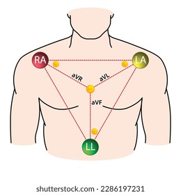 Augmented Limb Leads EKG - Einthoven Dreieck - Elektrokardiogramm - Medizinische Vektorgrafik