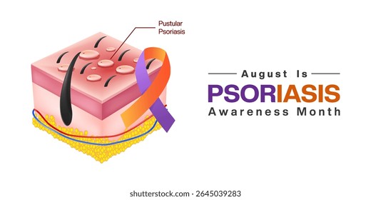 August is Psoriasis Awareness Month. Pustular psoriasis and ribbon. Suitable for posters, banners and social media. White background.