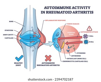 Autoimmune activity in rheumatoid arthritis skeletal disease outline diagram. Labeled educational scheme with body immune system attack to tissues with cells vector illustration. Bone inflammation.