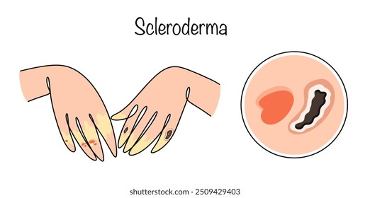 Doença autoimune do tecido conjuntivo. Caracteriza-se pela deposição de tecido cicatricial em toda a pele ou em suas áreas individuais. Uma manifestação da doença feita à mão em mãos humanas.