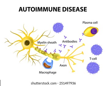 Autoimmune Disease. Multiple Sclerosis - Immune Cells Attack The Myelin Sheath That Surrounds Nerve Cells.  Antibodies Initiate Myelin Injury (macrophage Activation). 