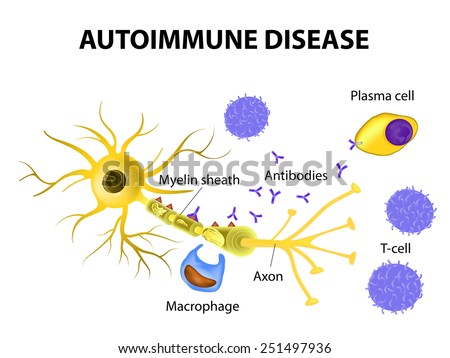 Autoimmune Disease. Multiple sclerosis - Immune cells attack the myelin sheath that surrounds nerve cells.  Antibodies initiate myelin injury (macrophage activation). 