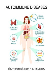 autoimmune diseases. Tissues of the human body affected by autoimmune attack. Disease and organs on silhouette woman. anatomic illustration