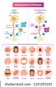 Autoimmune diseases vector illustration. Various illness collection set. Constant stress damage and labeled medical explanation. Leaking gut and AIP paleo diet reasons.