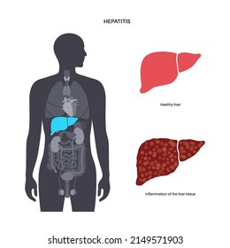 Autoimmune Hepatitis Disease. Healthy Organ And Liver With Inflammation, Viral Infection. Virus, Pain And Inflammation In The Human Body. Disease Of Digestive System Medical Flat Vector Illustration.