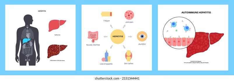 Autoimmunhepatitis. Symptome und Behandlung. Leberentzündung, Virusinfektion. Virus, Schmerzen und Entzündungen in den menschlichen Organen. Erkrankungen des Verdauungssystems, medizinische Vektorgrafik.