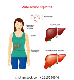 Autoimmune Hepatitis. Autoimmune Disease When Immune System Attacks Liver Cells Causing The Liver To Be Inflamed. Vector Illustration For Medical Use