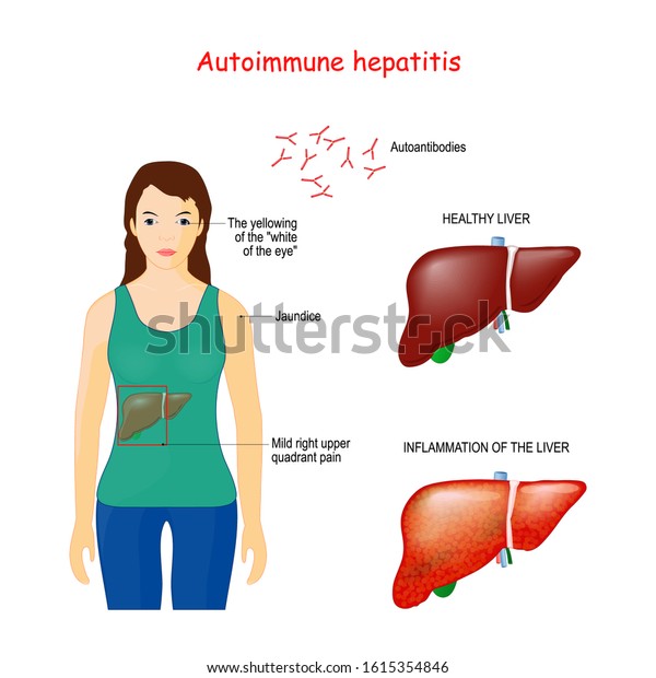 Autoimmune Hepatitis Autoimmune Disease When Immune Stock Vector Royalty Free 1615354846