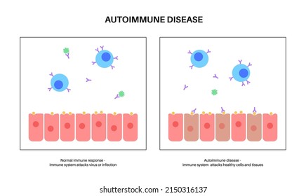 Autoimmune Hepatitis On Microscope. Healthy Organ And Liver With Inflammation, Viral Infection. Virus, Pain And Inflammation In The Human Body. Disease Of Digestive System Flat Vector Illustration