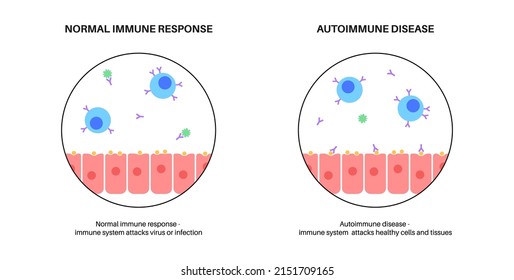 Autoimmune hepatitis on microscope. Healthy organ and liver with inflammation, viral infection. Virus, pain and inflammation in the human body. Disease of digestive system flat vector illustration