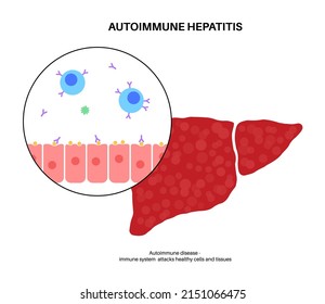 Autoimmune Hepatitis On Microscope. Symptoms And Treatment. Liver Inflammation, Viral Infection. Virus, Pain And Inflammation In The Human Body. Disease Of Digestive System Vector Illustration