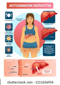 Autoimmune hepatitis vector illustration. Labeled diagram with disease symptoms. Medical scheme with leaking gut that causes liver inflammation and cirrhosis with scars.