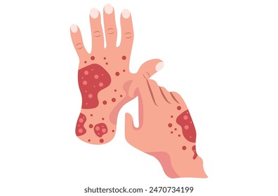 Autoimmune progesterone dermatitis,urticaria,Bullous pemphigoid,herpetiformis,Dermatomyositis,Epidermolysis bullosa acquisita,Gestational,Hidradenitis suppurativa,Lichen planus,Linear IgA,Psoriasis