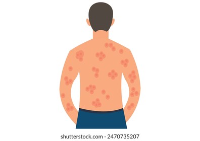 Autoimmune progesterone dermatitis,urticaria,Bullous pemphigoid,herpetiformis,Dermatomyositis,Epidermolysis bullosa acquisita,Gestational,Hidradenitis suppurativa,Lichen planus,Linear IgA,Psoriasis