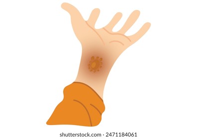 Autoimmune progesterone dermatitis,urticaria,Bullous pemphigoid,herpetiformis,Dermatomyositis,Epidermolysis bullosa acquisita,Gestational,Hidradenitis suppurativa,Lichen planus,Linear IgA,Psoriasis