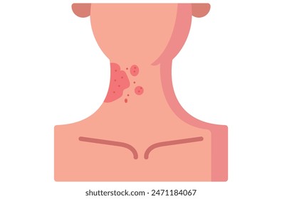 Autoimmune progesterone dermatitis,urticaria,Bullous pemphigoid,herpetiformis,Dermatomyositis,Epidermolysis bullosa acquisita,Gestational,Hidradenitis suppurativa,Lichen planus,Linear IgA,Psoriasis