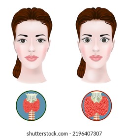 Autoimmune Therioditis. Enlargement Of The Thyroid Gland And Protrusion Of The Eyes. Disease Infographic. Medical Poster. Vector Illustration