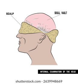 Autopsy, preparation of the brain vault for incision.
