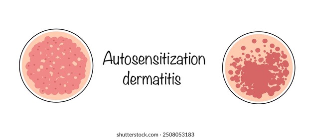 Autosensitization dermatitis. A skin disease of an allergic nature, which is manifested by the formation of inflamed lesions on the skin. Vector illustration.