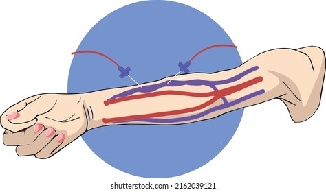 Av Fistula For Dialysis Vactor