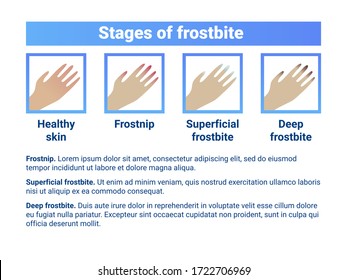 41 Frostbite Stage Images, Stock Photos & Vectors | Shutterstock