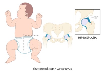 Baby birth and prosthesis damage thighbone joint dislocated broken pain of leg bone treat unstable femur pelvis chronic sport nerve sciatic compression labral tear child hurt thigh closed loose neck