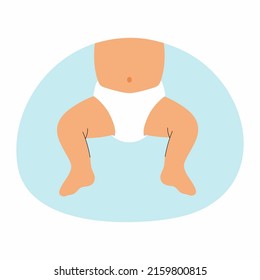 Baby In Diaper. Hip Dysplasia. Vector Illustration.