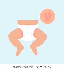 Baby with diaper rash.  Allergic itching, skin inflammation, redness and irritation. Dermatological problems in children. Vector illustration