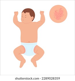 Bebé con erupción de pañales.  Picor alérgico, inflamación cutánea, enrojecimiento e irritación. Problemas dermatológicos en niños. Ilustración del vector