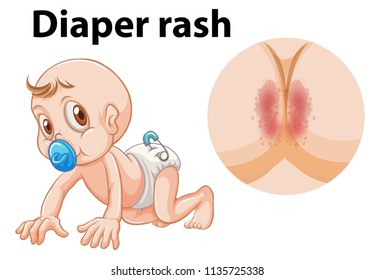 A Baby With Diaper Rash Illustration