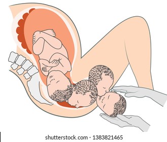 Baby Fetus in Pregnant Woman's belly - medical illustration