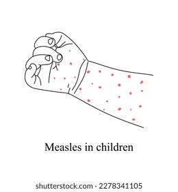 Baby hand with a red rash on the skin. Infectious viral disease causing fever and a red rash on the skin, typically occurring in childhood. Health care linear vector illustration