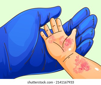 Baby hand with skin disease. Itching, scabies. Healthcare illustration. Vector illustration.