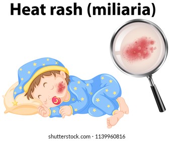 A Baby With Heat Rash Illustration