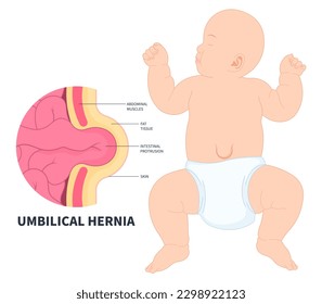 baby infant abdominal stomach pain umbilical hernia of inguinal incisional Femoral diastasis recti volvulus constipation intestine Hiatus birth belly button small large ileus lump navel wall cavity