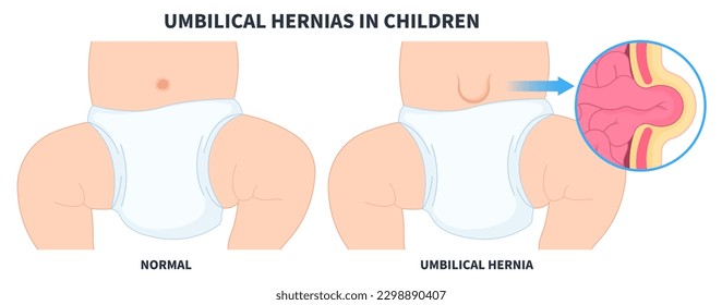 baby infant umbilical hernia of inguinal incisional Femoral stomach pain abdominal diastasis recti volvulus constipation intestine Hiatus birth belly button small large ileus lump navel wall cavity