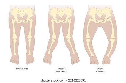 Baby Leg With Knock Knees The Bone Disease Anatomy In Medical