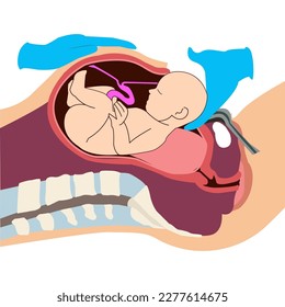 Baby removal during childbirth through caesarean section. Fetus movement during the c-section. Biology and gynecology