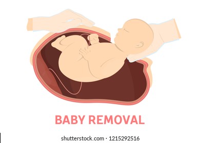 Baby removal stage of birth via cesarean section. Fetus movement during the c-section. Biology and gynecology. Isolated vector illustration