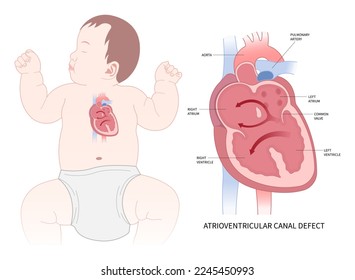 Corazón de bebé con aneurisma septal auricular que causa latidos o arritmias irregulares